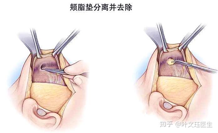 婴儿肥就去颊脂肪垫 为什么不建议你这么做?