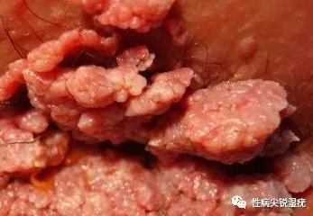 男朋友在分手期间找了新女朋友并且得了尖锐湿疣复合之后再发现我该