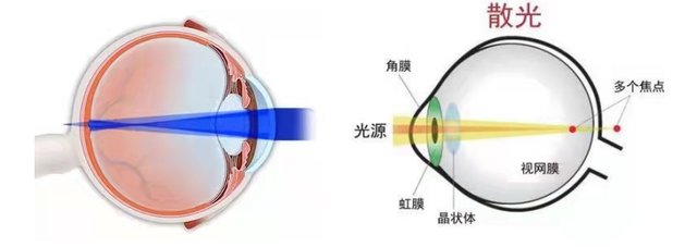 发现孩子散光,长大后能恢复吗? 