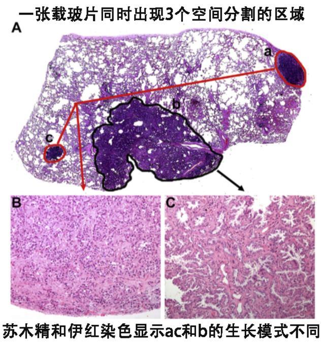 手術中的冰凍切片顯示多發性肺腺癌