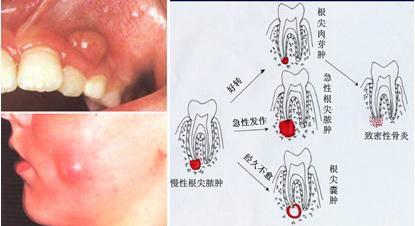 根尖周炎是怎么样的 也会牙疼吗 知乎