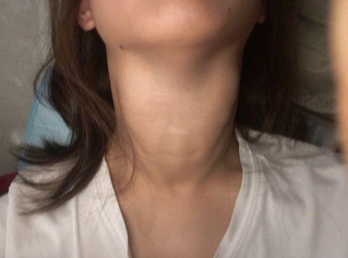 女性甲状腺结节四宗罪这病为啥开始对年轻女性下手
