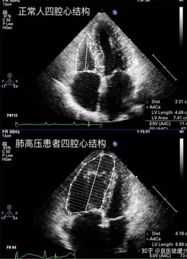 肺动脉交叉超声图片图片