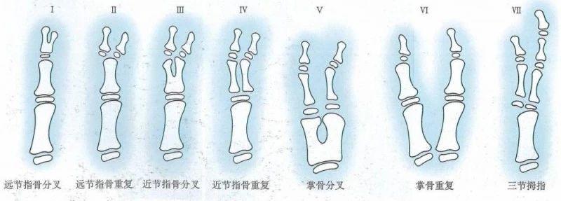 足趾畸形分类图片