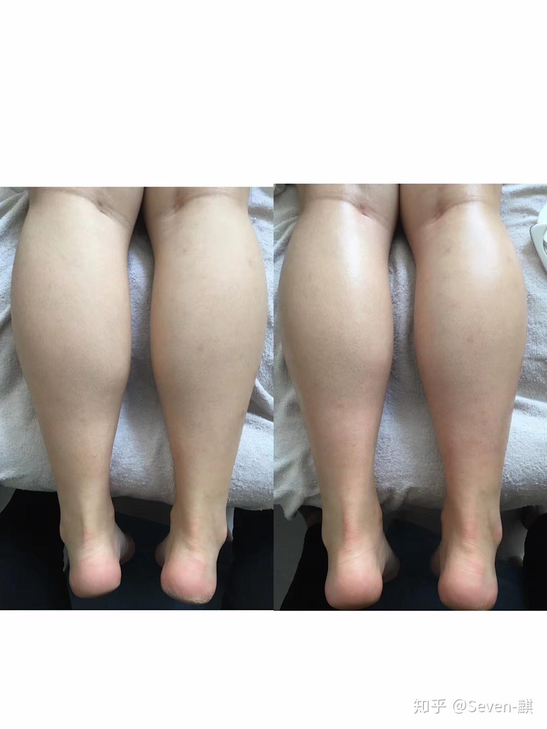 肌肉型萝卜腿怎么减