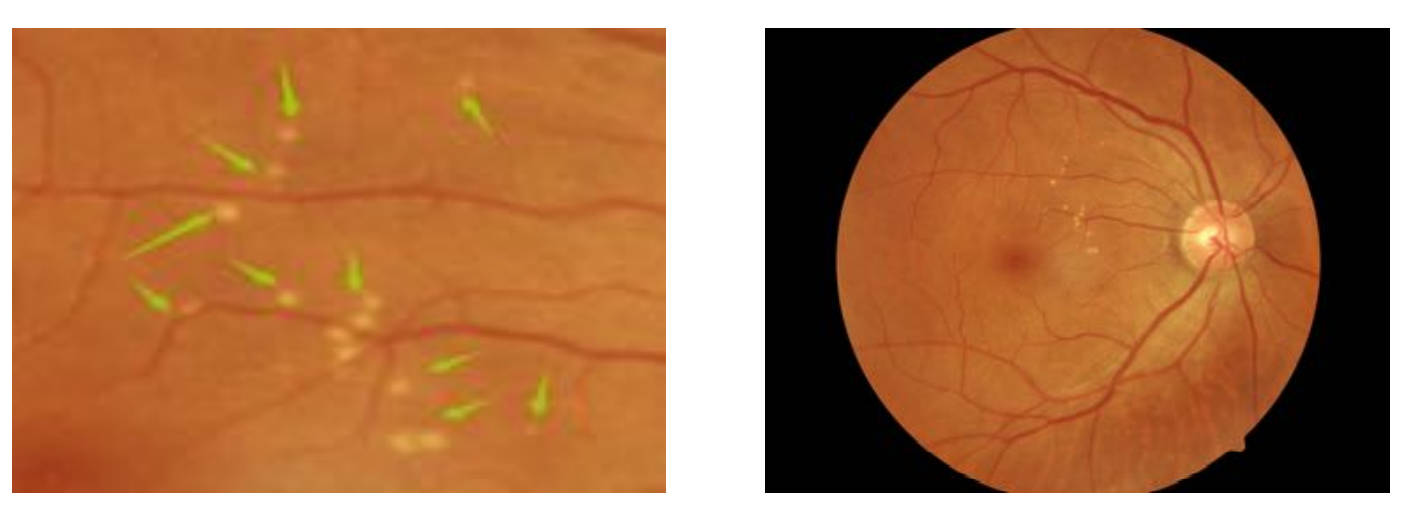 视盘玻璃膜疣oct图像图片