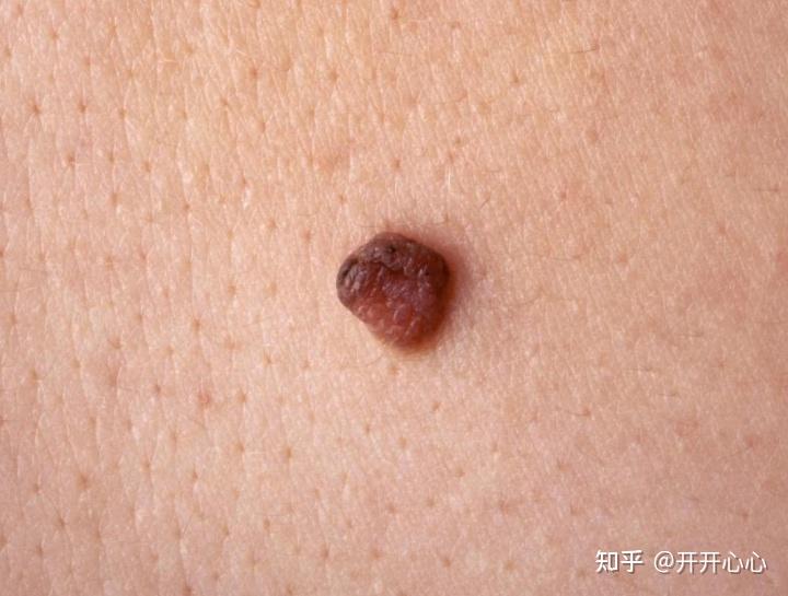 女性"下面"总是瘙痒,长"痘痘",劝你别大意,早查hpv - 知乎