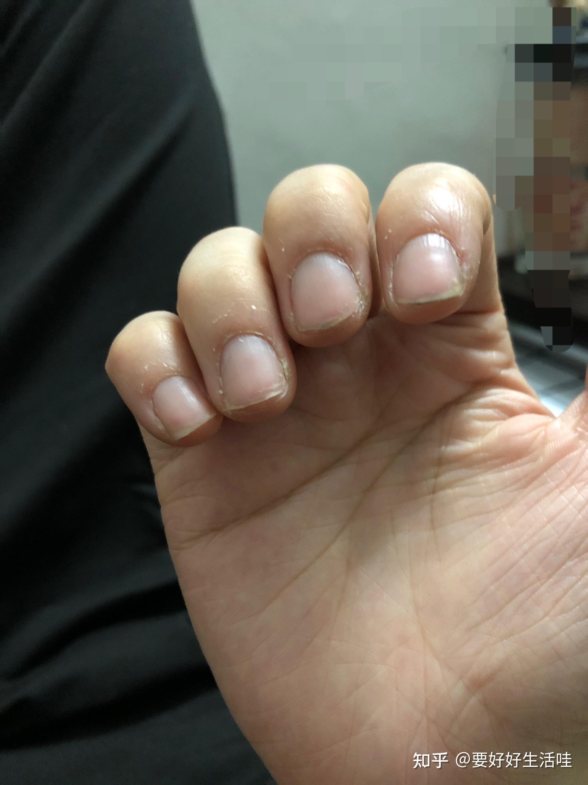 指甲白点、竖纹、月牙代表身体不健康？什么样的指甲是疾病的信号(竖纹)