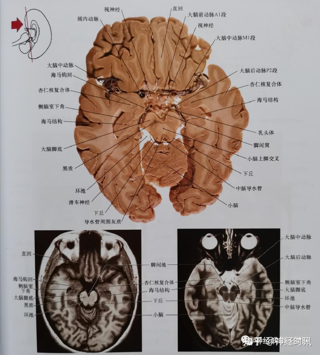 临床神经解剖图谱(断层影像+切片) - 知乎