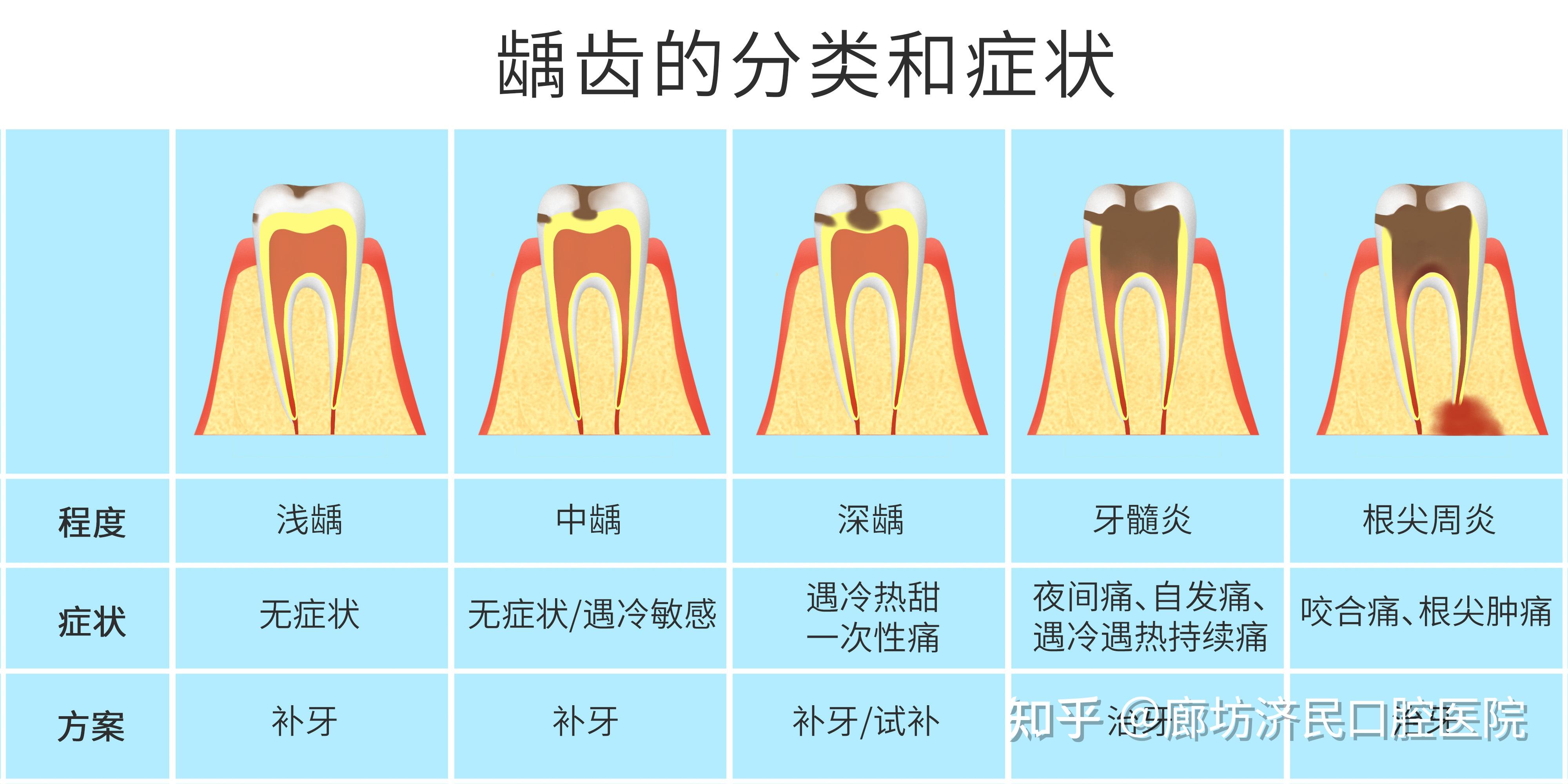 关于补牙,你必须知道的事! - 知乎
