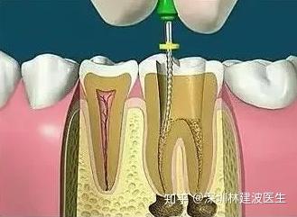 1,揭開髓腔去淨腐質和原有充填物,看到整個髓底解剖結構以便後續治療