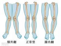 如何矫正x形腿