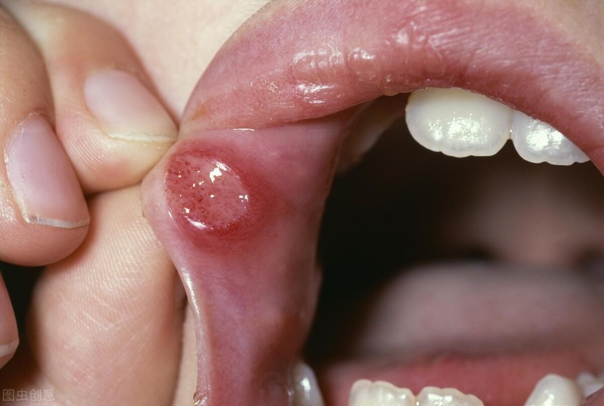 舌头溃疡照片舌癌图片