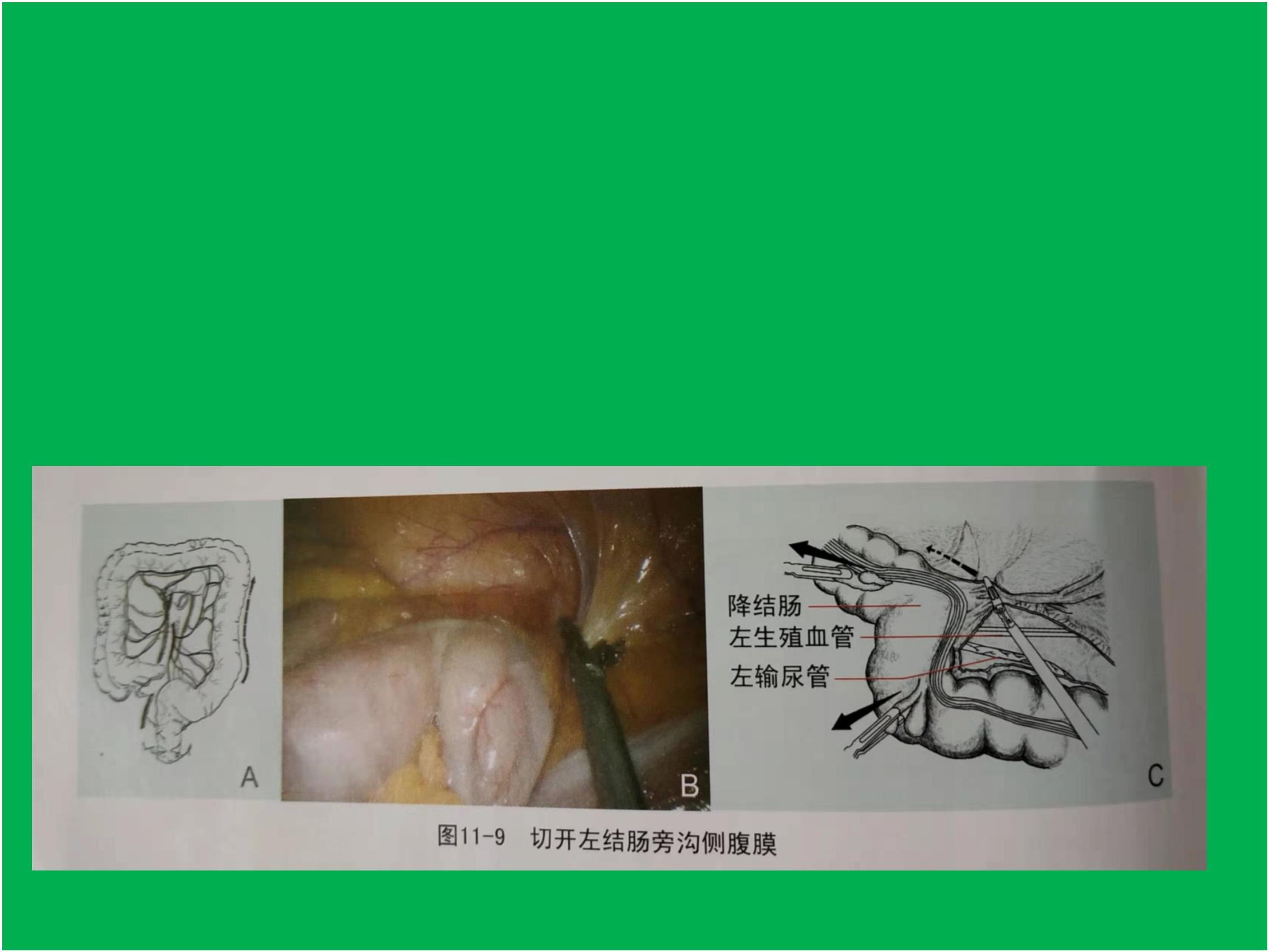 腹腔镜右半结肠体位图片