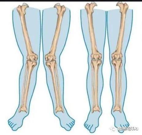 当下肢肌肉力量失衡后,大腿骨会向内旋转,然后也会带动小腿骨向内旋