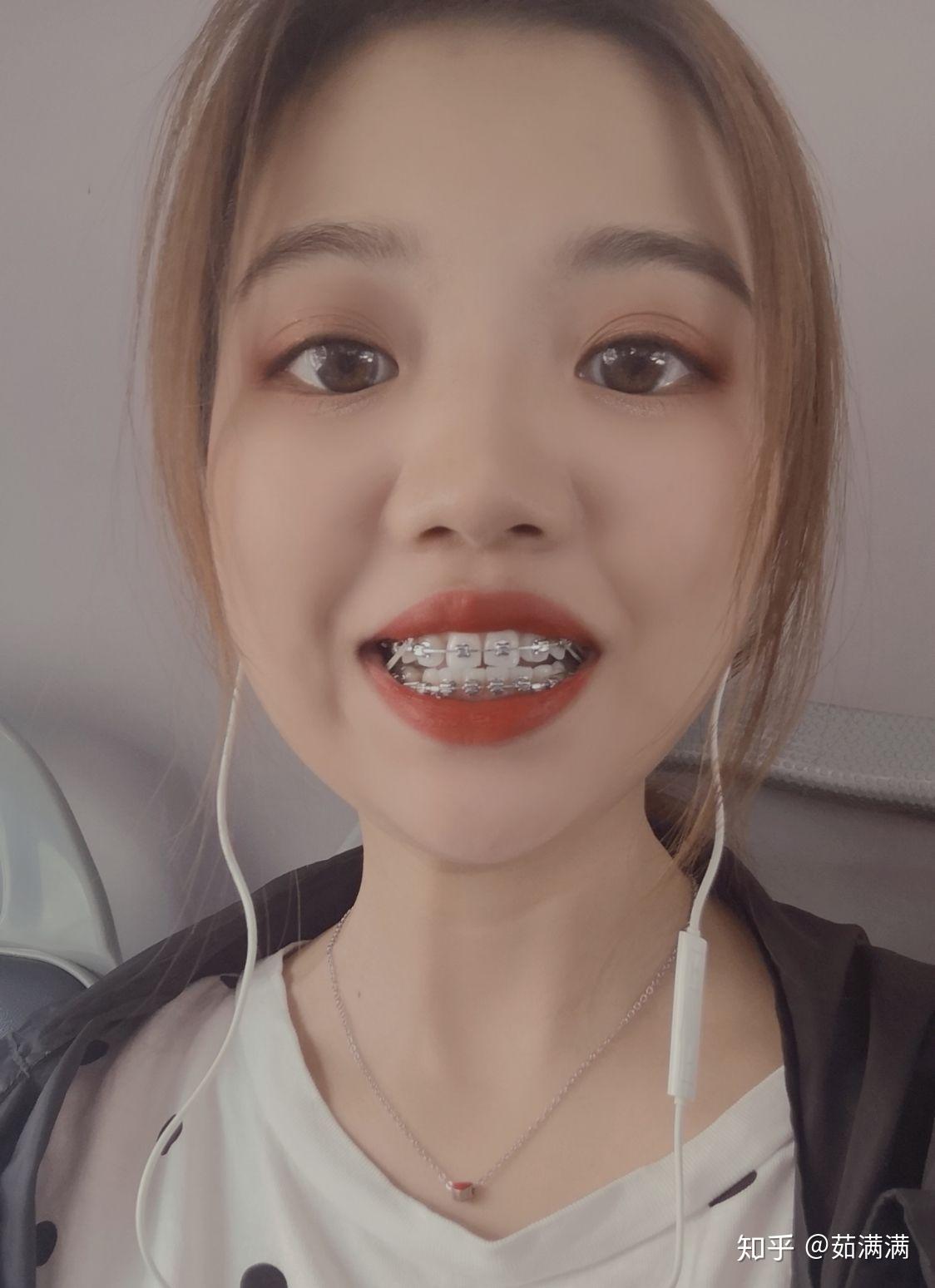 与牙套君相亲相爱的日子