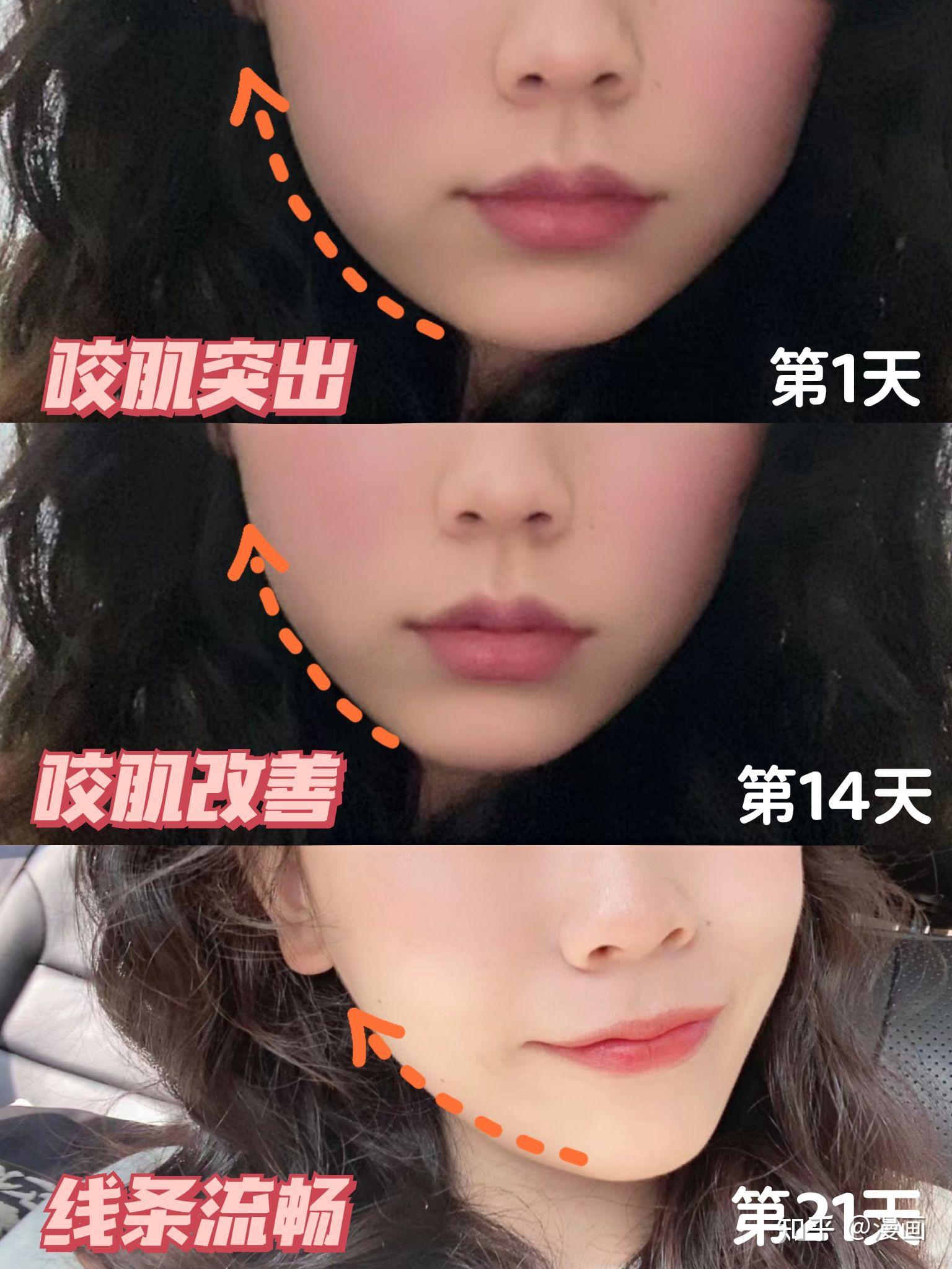 4个动作21天瘦咬肌！男女都可 - 知乎