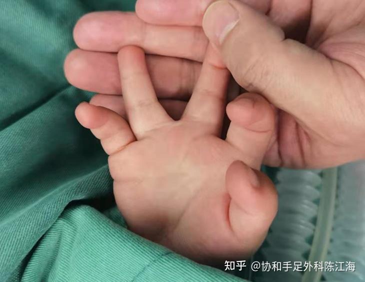 并指的最佳手术时间并指合并别的手足畸形治疗效果二