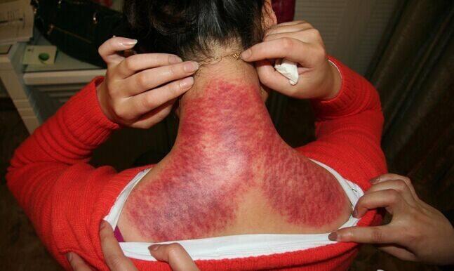 中医科普间刮了那么多年痧到底什么是痧