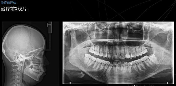 姑娘主诉:嘴突,牙齿非常不整齐,笑起来虎牙不美观,有开唇露齿现象.