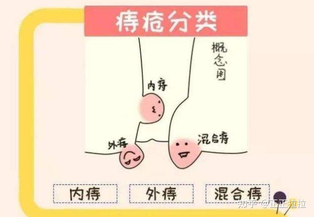 痔疮怎么治7种小方法15天告别痔疮