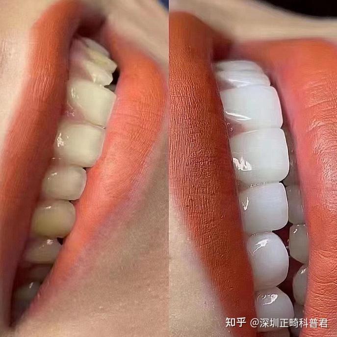 牙齿美白后注意这几点 效果维持更久!