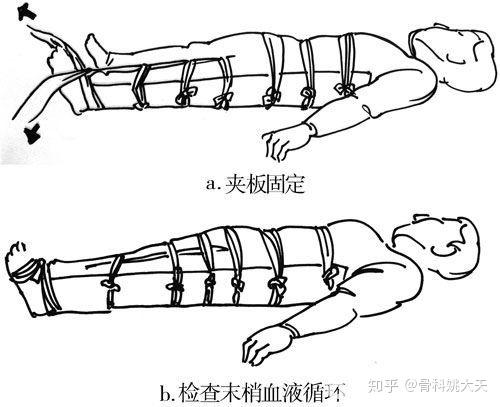 大腿骨折术后如何上厕所 知乎