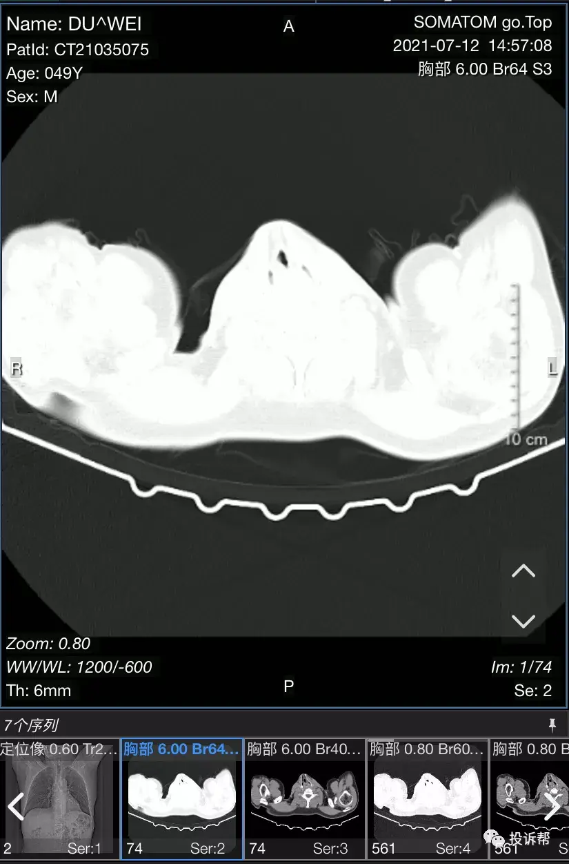ct检查不出来,又没有长肿瘤,没有破裂,也没有出血……膈肌脚在膈肌