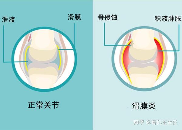 膝盖肿痛,滑囊炎还是滑膜炎,哪个更难治? - 知乎