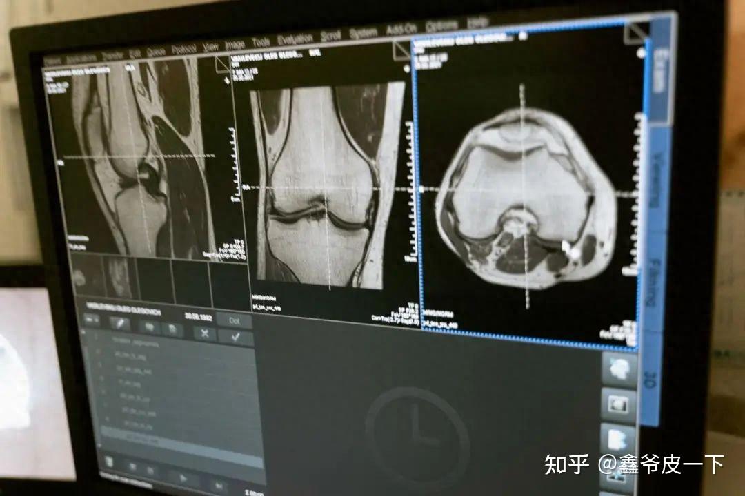 骨科拍片,X射线、CT、核磁共振到底有什么区别?(通俗版) - 知乎