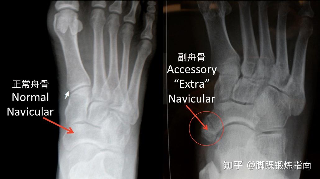 足舟骨突出能按进去吗图片