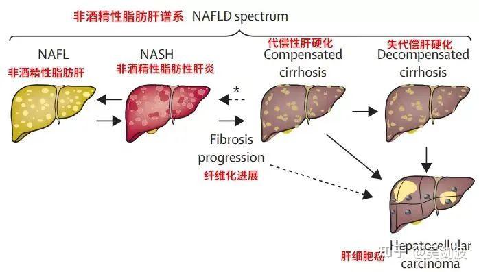 中医治疗脂肪肝的两种路数——讲讲实脾散、逍遥散这个方子 知乎