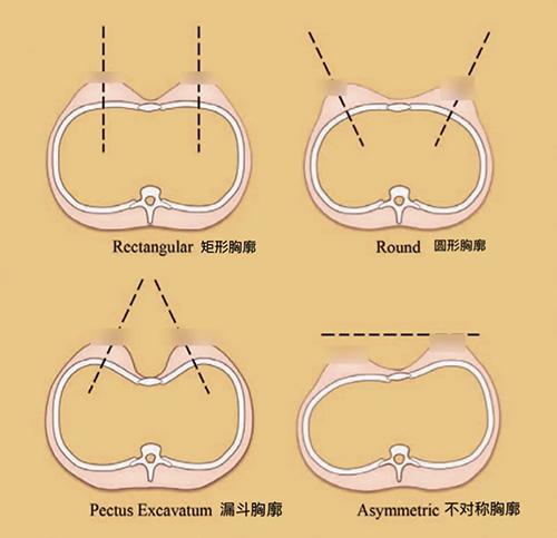 杨大平教授科普集胸廓发育影响乳房及乳头的形态