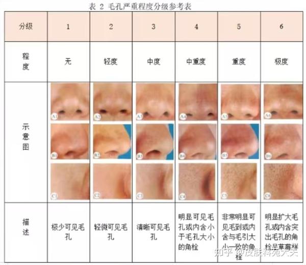 毛孔粗大可选择的治疗方案综述:疗效及副作用 - 知乎