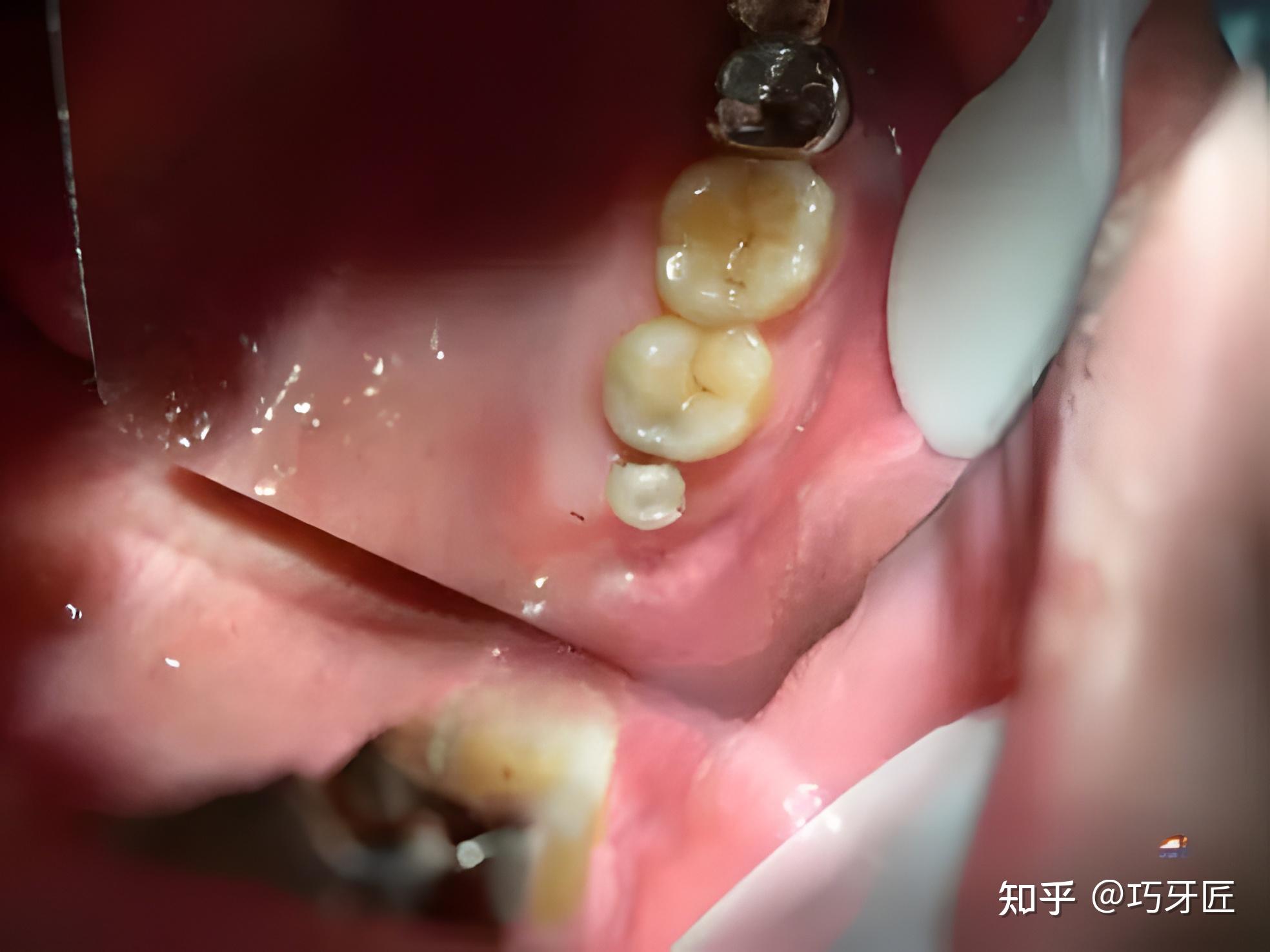 牙医必备收藏的图片合集口腔常见的疾病图片