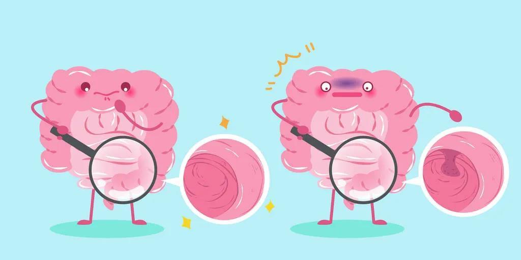 肠息肉中,以结肠和直肠息肉最多见,即结肠,直肠黏膜表面的一种隆起性