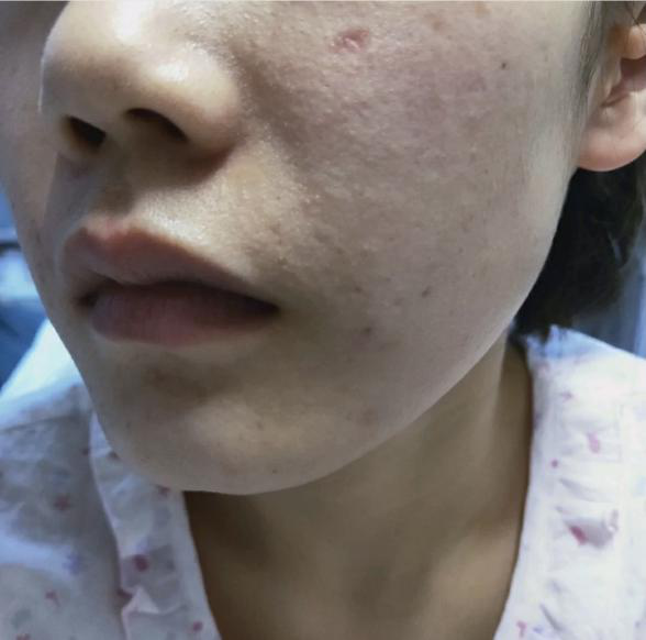 40岁以后皮肤泛红敏感红血丝怎么办2外用篇