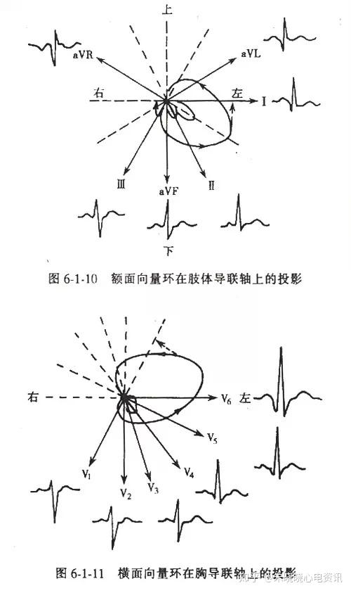 (三),心肌梗死的定位诊断