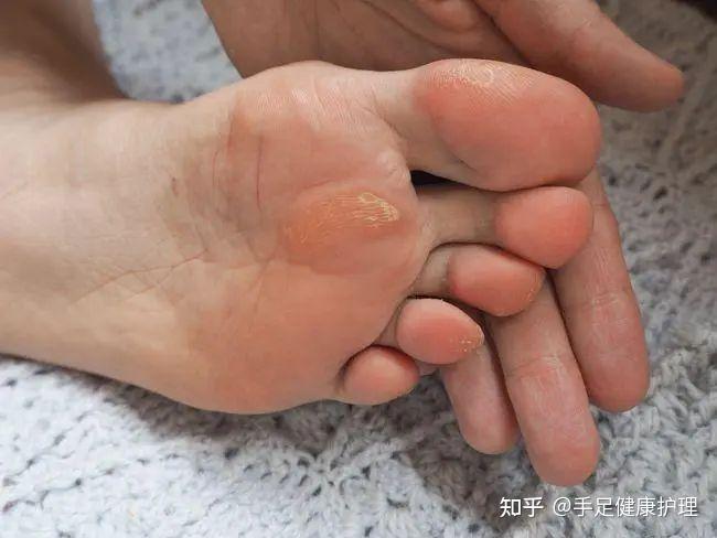 脚垫?胼胝?鸡眼?跖疣?刺猴?傻傻分不清? - 知乎
