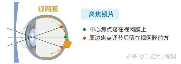 离焦镜片是什么?如何使用离焦镜片?宁波太学眼科释疑 - 知乎
