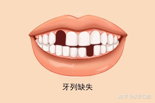 牙体,牙列缺损与牙列缺失的区别! - 知乎