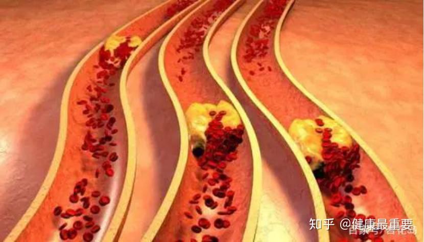关注血液健康,注意高血脂症!