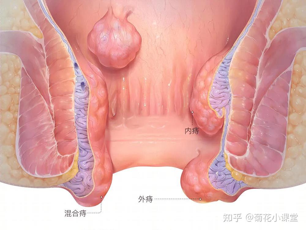 晚期内痔肛瘘直肠脱垂肛门尖锐湿疣肛周湿疹排除以上病史后,肛门部有