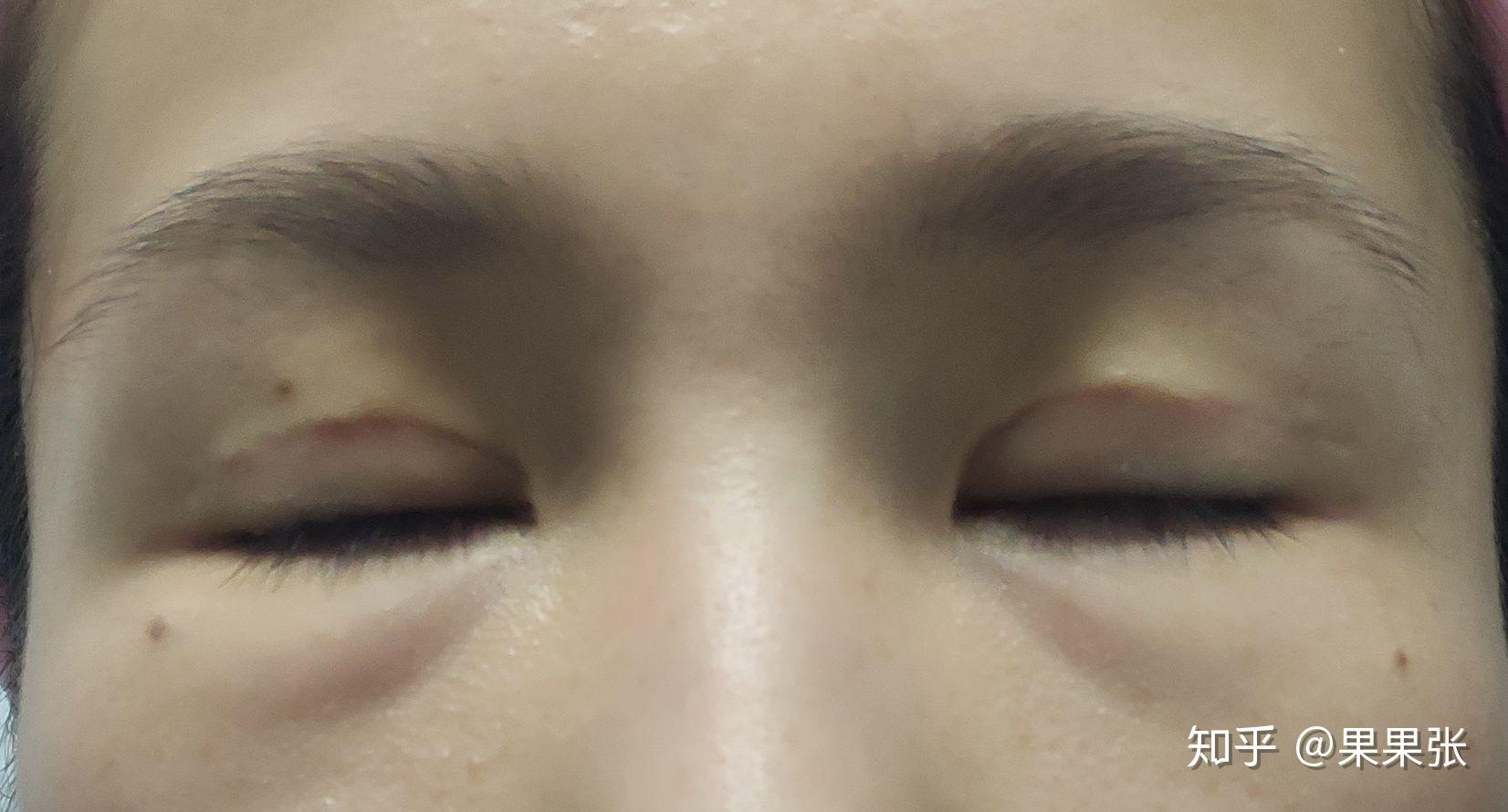 全切双眼皮全程＋术后护理🙌这样闭眼无痕 真是没想_圈子-新氧美容整形