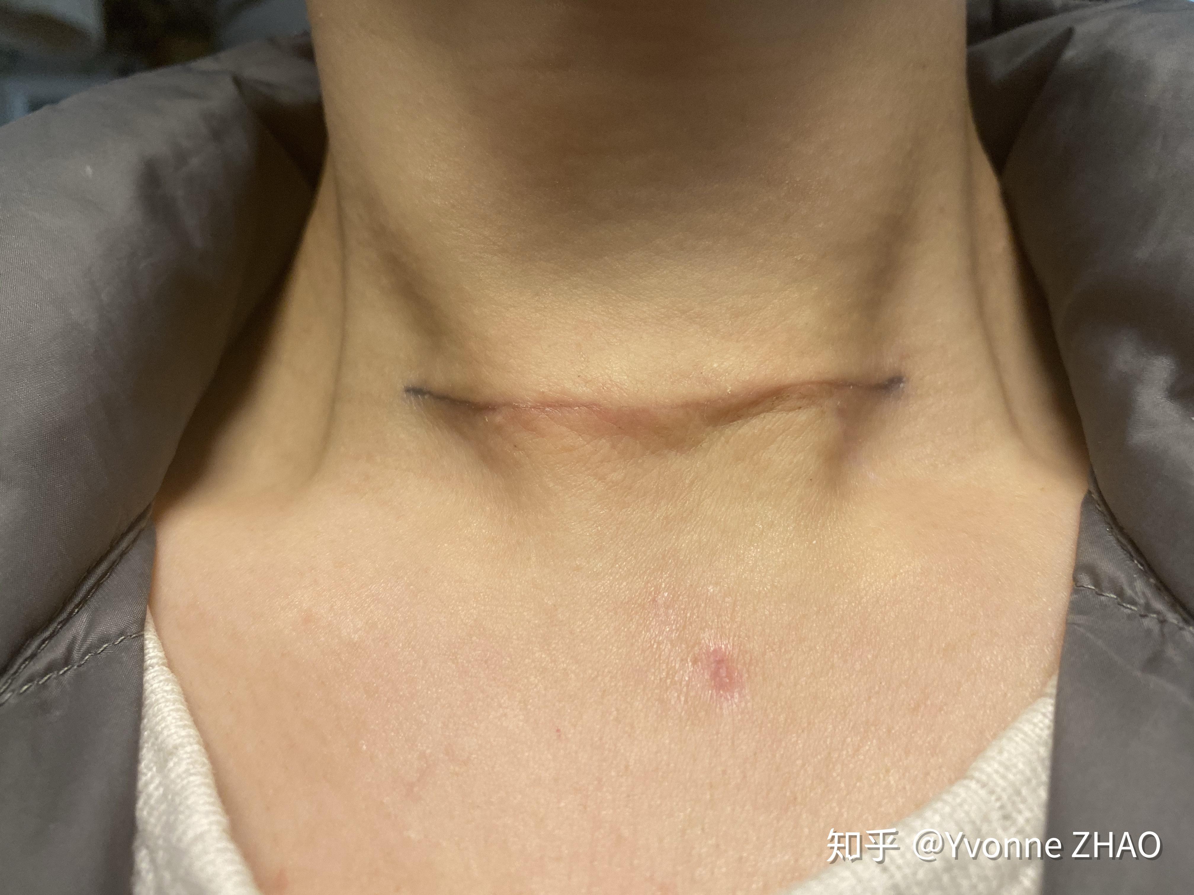 甲状腺结节手术刀口图片