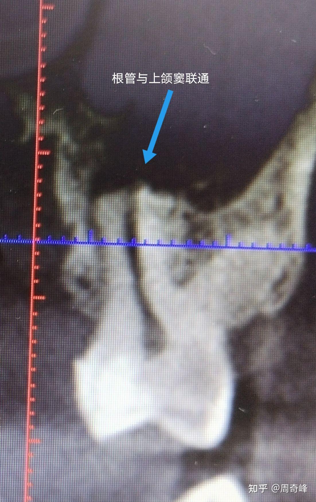 病例312 上颌窦含齿囊肿-特种医学-医学