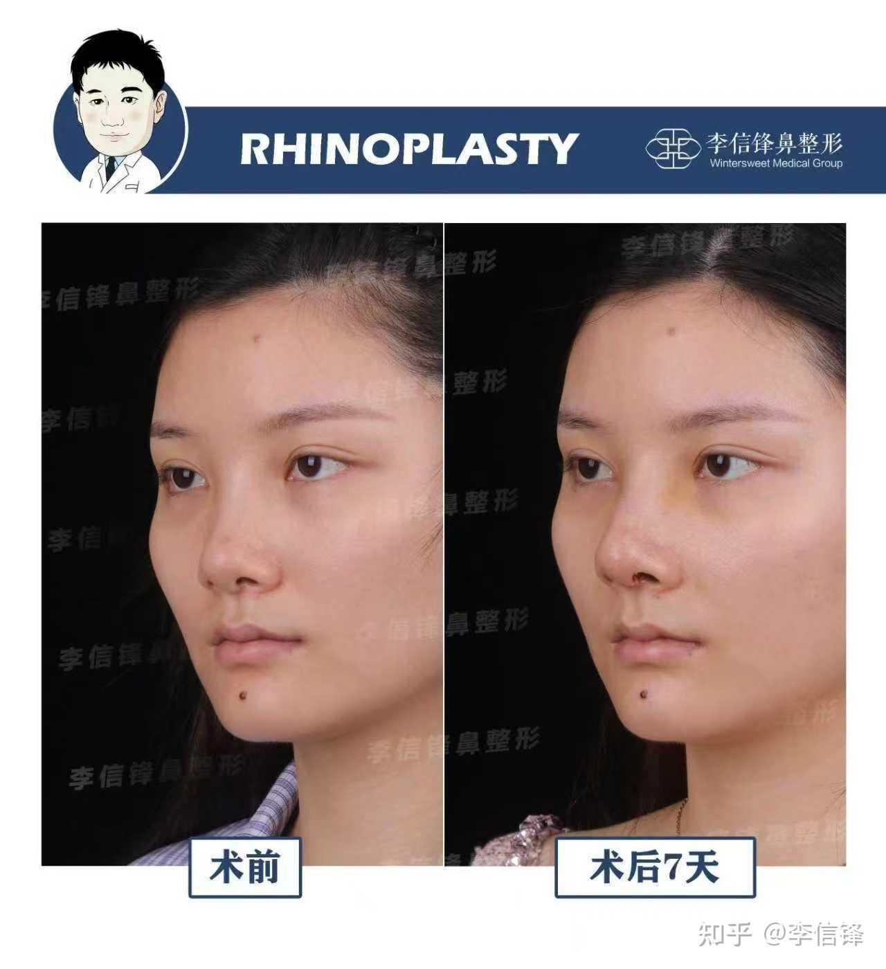 初鼻鼻综合-鼻梁矮塌、鼻头圆钝,鼻基底凹陷改善,术后七天对比~ - 知乎