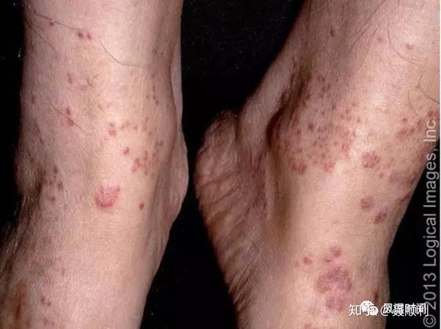 也可以叫單純性紫癜(purpura simplex),毛細血管炎(capillaritis)