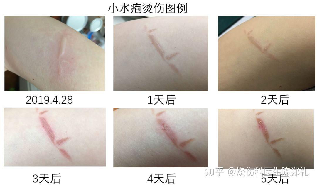 关于伤口处理的8个误区 - 知乎