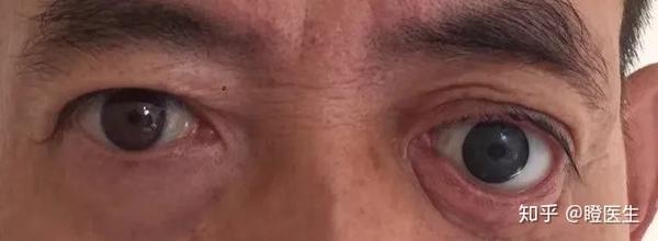 眼球摘除后如何面对生活 眼科医生带你揭开 假眼 的神秘面纱 知乎